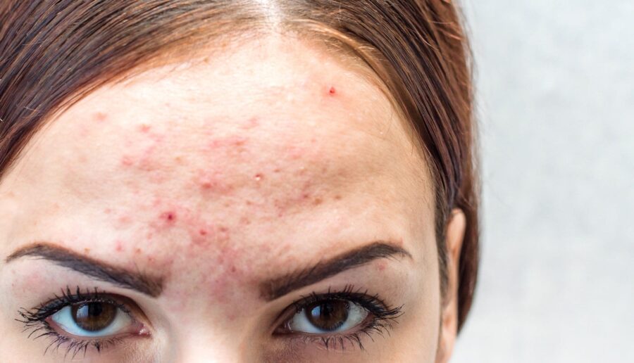 acne-treatment-solutions-for-worst-cases - جوش دوران بلوغ