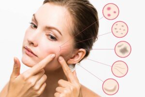 حساسیت پوست چیست؟ Acne-problem