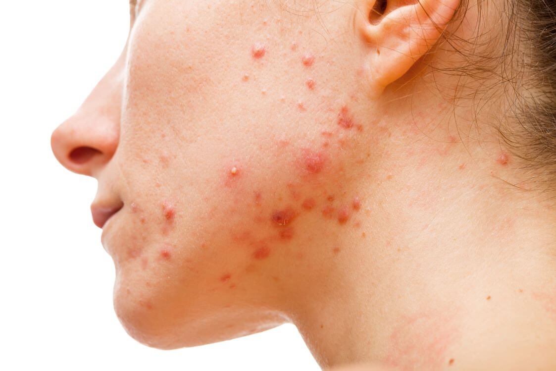 از بین بردن جای جوش